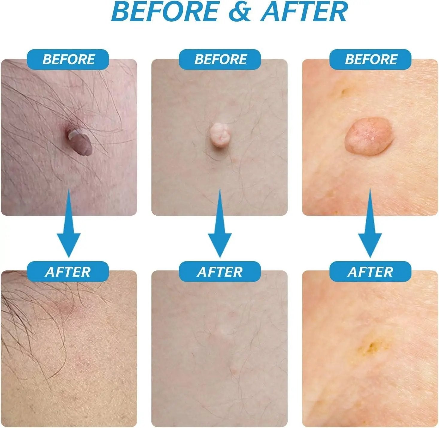 2 in 1 Skin Tag Remover Kit - Painless 9ttgn1-6x